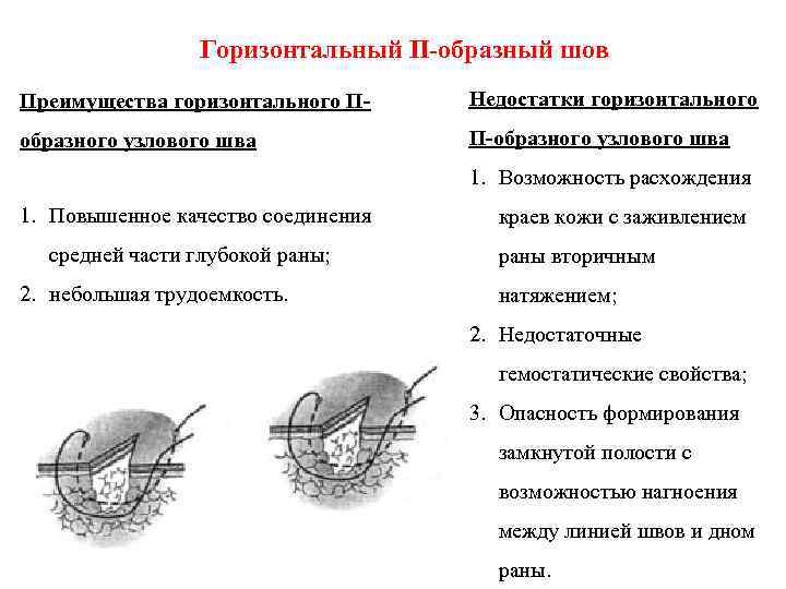 Горизонтальный П-образный шов Преимущества горизонтального П- Недостатки горизонтального образного узлового шва П-образного узлового шва