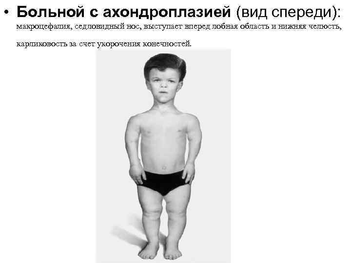  • Больной с ахондроплазией (вид спереди): макроцефалия, седловидный нос, выступает вперед лобная область
