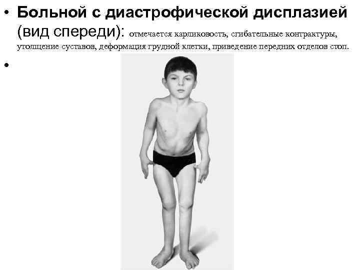  • Больной с диастрофической дисплазией (вид спереди): отмечается карликовость, сгибательные контрактуры, утолщение суставов,