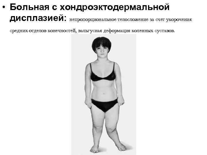 • Больная с хондроэктодермальной дисплазией: непропорциональное телосложение за счет укорочения средних отделов конечностей,