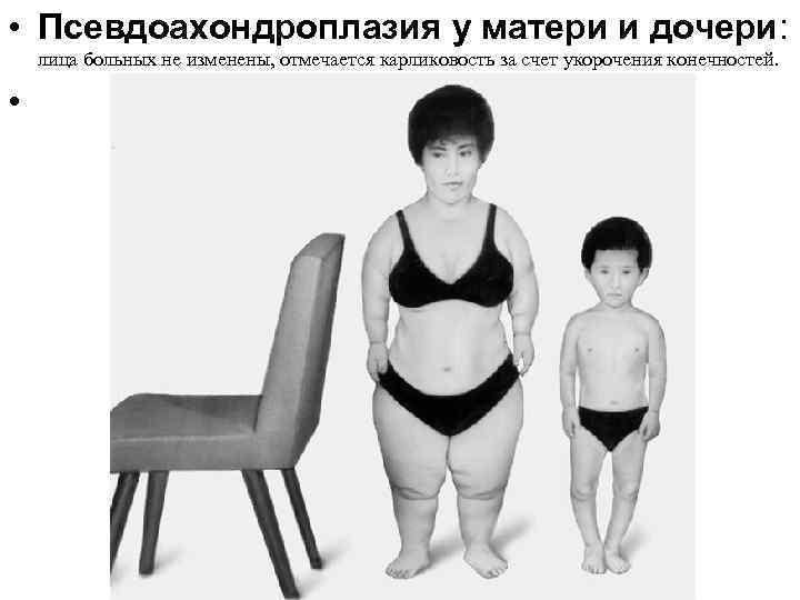  • Псевдоахондроплазия у матери и дочери: лица больных не изменены, отмечается карликовость за