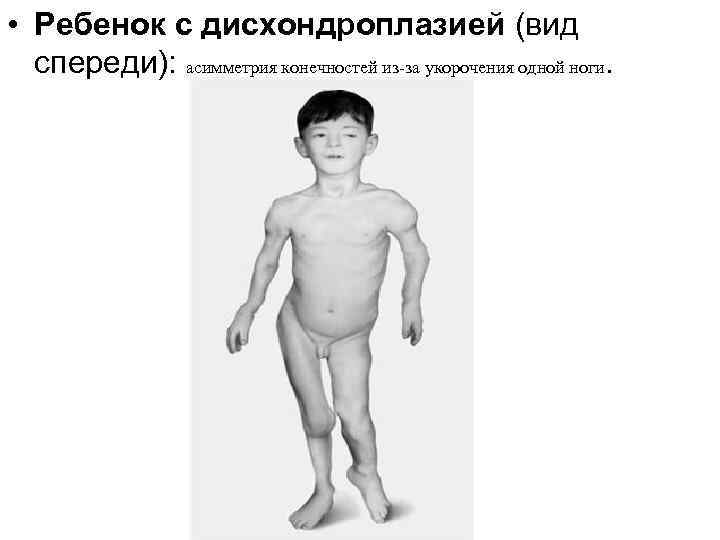 • Ребенок с дисхондроплазией (вид спереди): асимметрия конечностей из-за укорочения одной ноги. 
