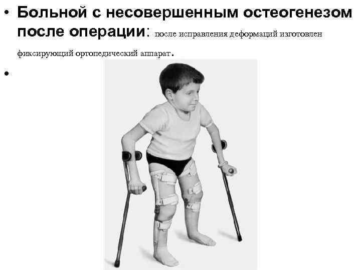  • Больной с несовершенным остеогенезом после операции: после исправления деформаций изготовлен фиксирующий ортопедический