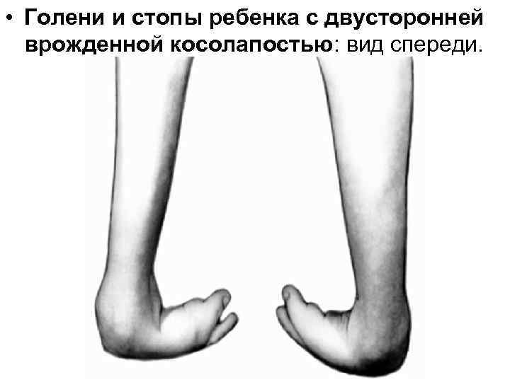  • Голени и стопы ребенка с двусторонней врожденной косолапостью: вид спереди. 