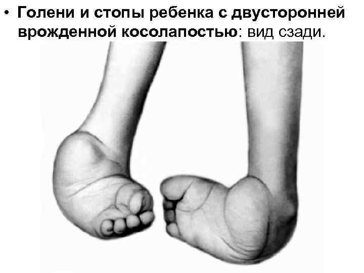  • Голени и стопы ребенка с двусторонней врожденной косолапостью: вид сзади. 