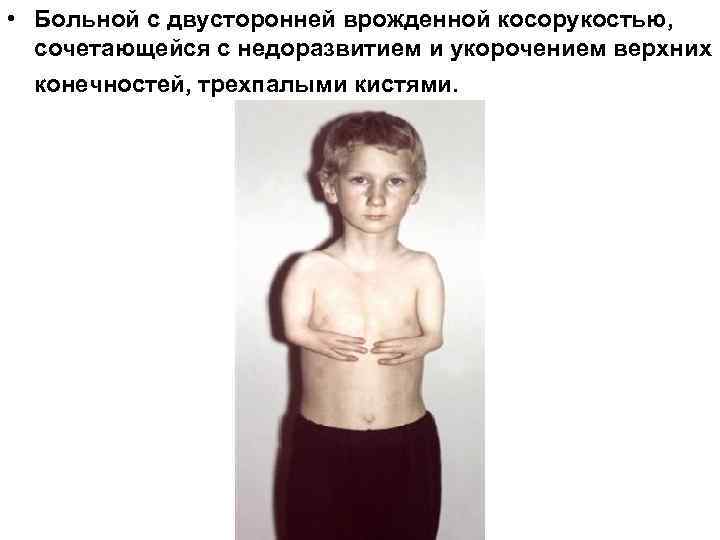  • Больной с двусторонней врожденной косорукостью, сочетающейся с недоразвитием и укорочением верхних конечностей,
