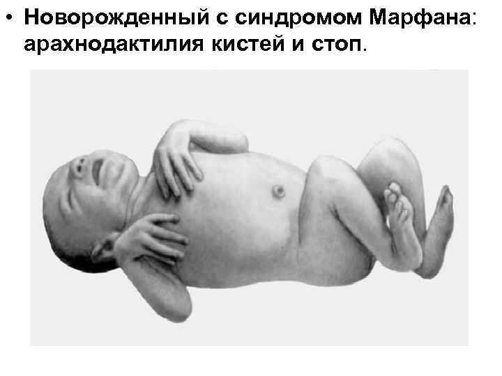  • Новорожденный с синдромом Марфана: арахнодактилия кистей и стоп. 