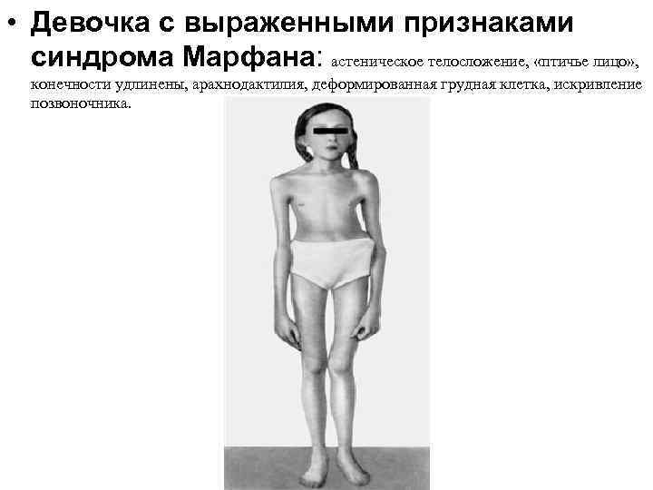  • Девочка с выраженными признаками синдрома Марфана: астеническое телосложение, «птичье лицо» , конечности