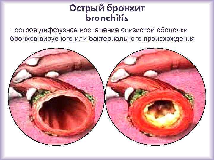 Острый бронхит bronchitis - острое диффузное воспаление слизистой оболочки бронхов вирусного или бактериального происхождения