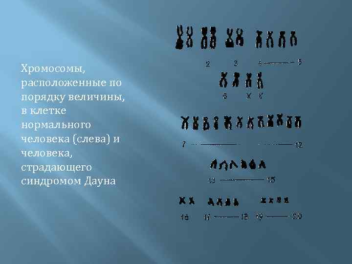 Хромосомы, расположенные по порядку величины, в клетке нормального человека (слева) и человека, страдающего синдромом