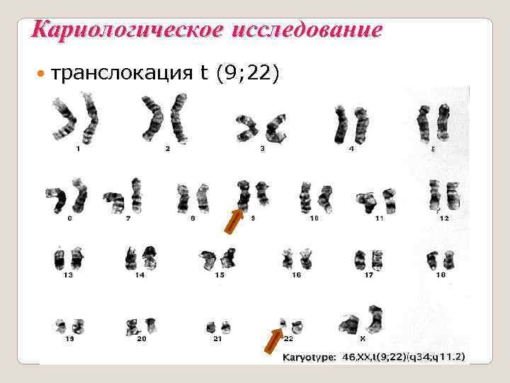 Кариологическое исследование транслокация t (9; 22) 