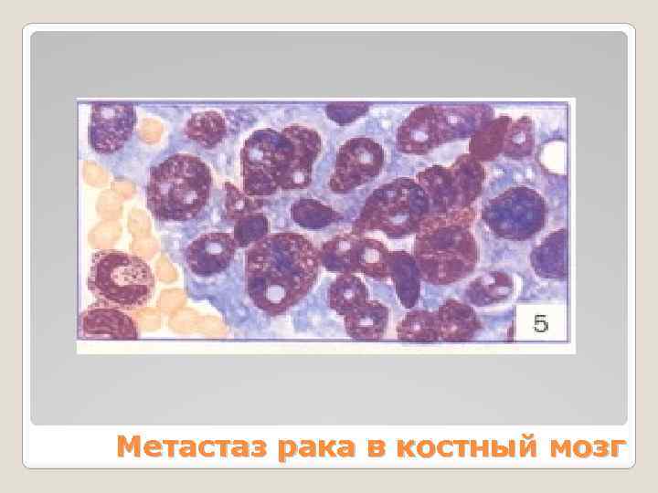 Метастаз рака в костный мозг 