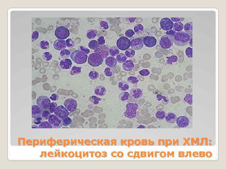 Периферическая кровь при ХМЛ: лейкоцитоз со сдвигом влево 