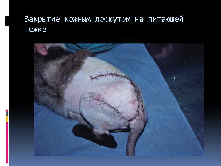 Закрытие кожным лоскутом на питающей ножке 