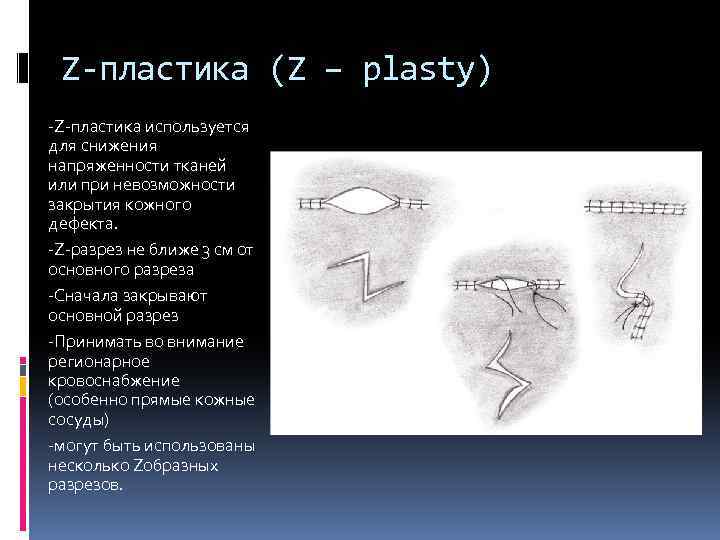 Z-пластика (Z – plasty) -Z-пластика используется для снижения напряженности тканей или при невозможности закрытия