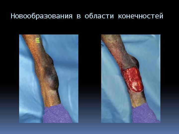Новообразования в области конечностей 
