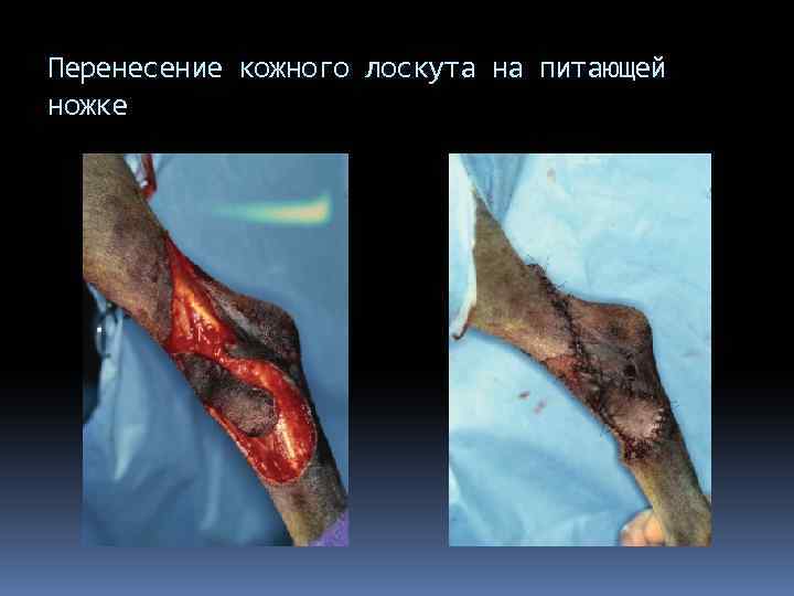 Перенесение кожного лоскута на питающей ножке 