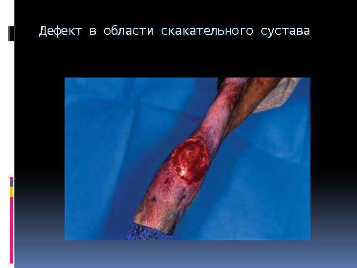 Дефект в области скакательного сустава 