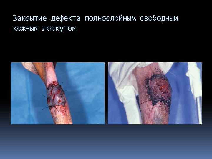 Закрытие дефекта полнослойным свободным кожным лоскутом 