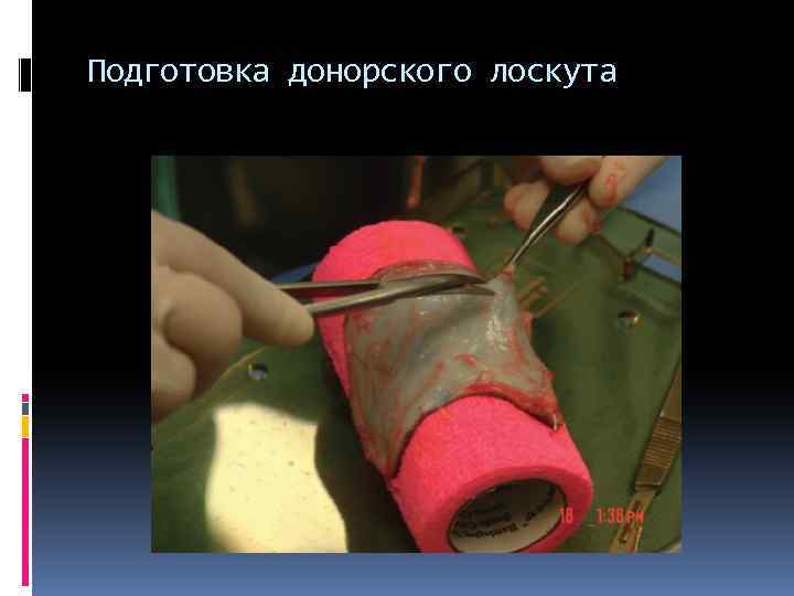 Подготовка донорского лоскута 