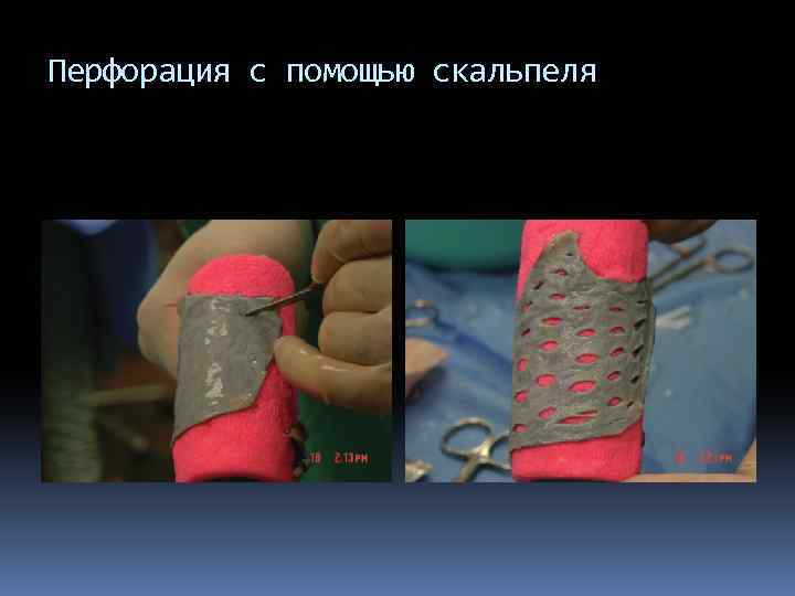 Перфорация с помощью скальпеля 