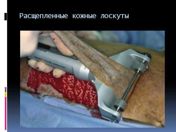 Расщепленные кожные лоскуты 