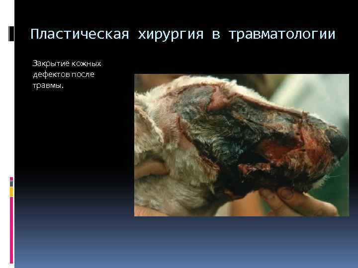 Пластическая хирургия в травматологии Закрытие кожных дефектов после травмы. 