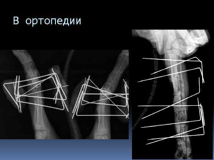 В ортопедии 