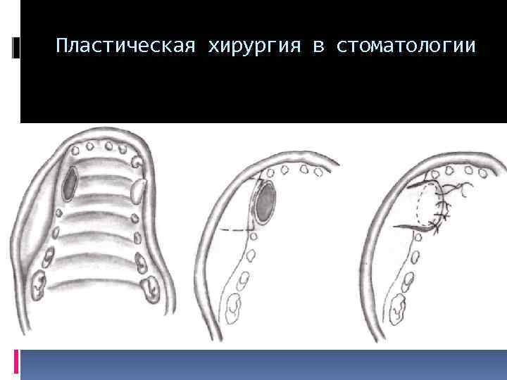 Пластическая хирургия в стоматологии 