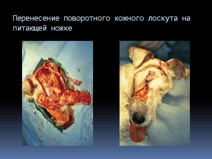 Перенесение поворотного кожного лоскута на питающей ножке 