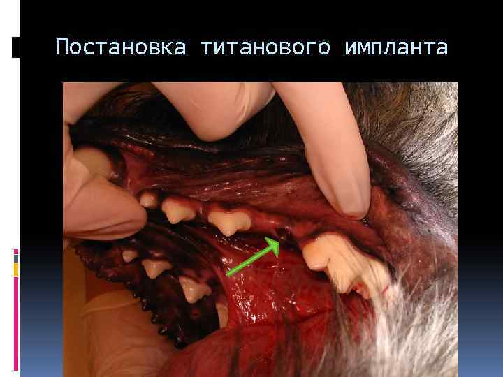 Постановка титанового импланта 