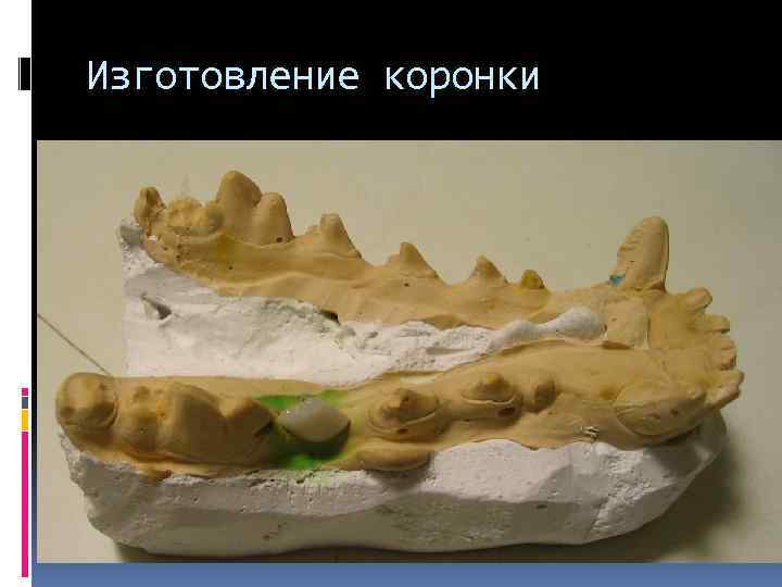 Изготовление коронки 