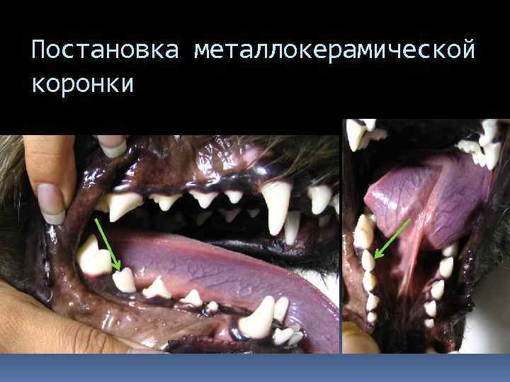 Постановка металлокерамической коронки 