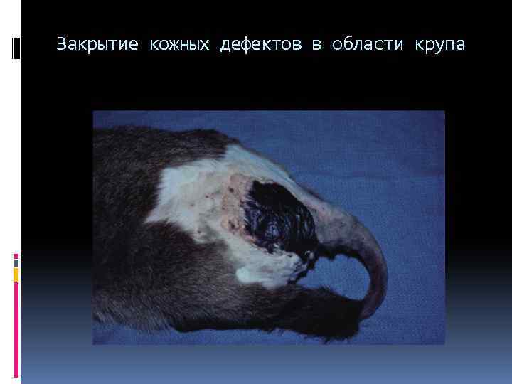 Закрытие кожных дефектов в области крупа 