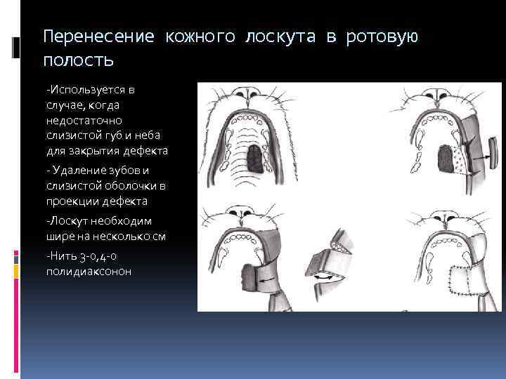 Перенесение кожного лоскута в ротовую полость -Используется в случае, когда недостаточно слизистой губ и