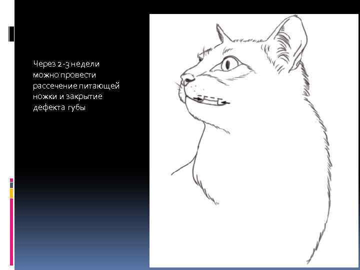 Через 2 -3 недели можно провести рассечение питающей ножки и закрытие дефекта губы 