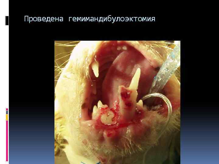 Проведена гемимандибулоэктомия 