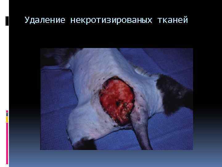 Удаление некротизированых тканей 