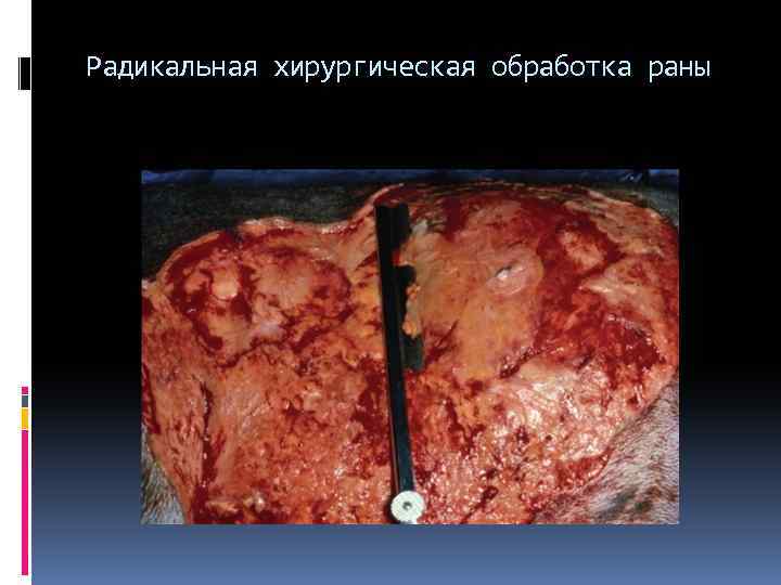 Радикальная хирургическая обработка раны 