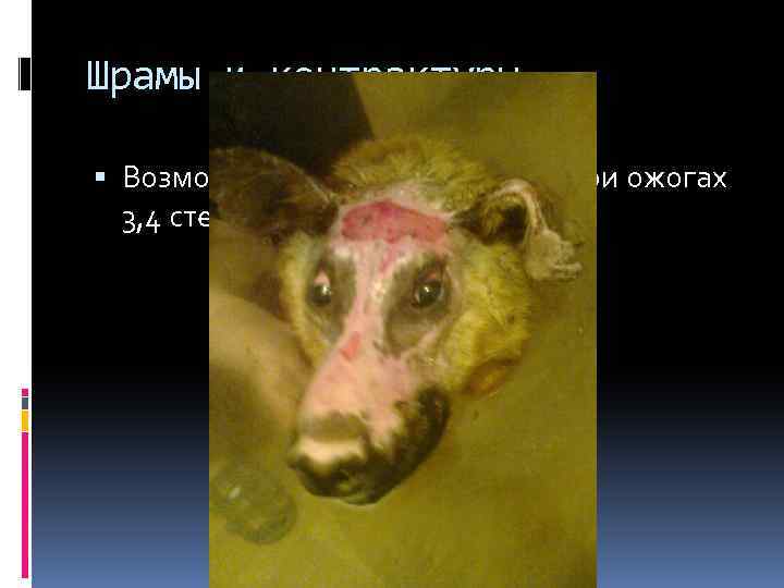 Шрамы и контрактуры Возможно образование только при ожогах 3, 4 степени. 