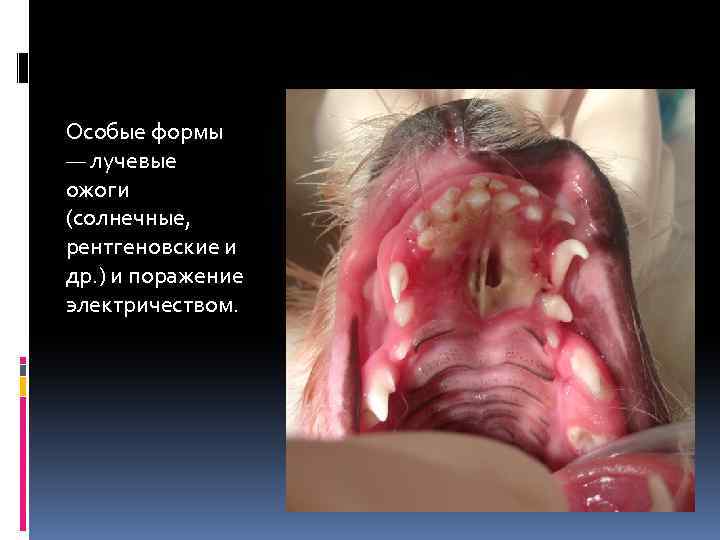 Особые формы — лучевые ожоги (солнечные, рентгеновские и др. ) и поражение электричеством. 