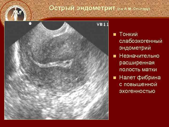 Острый эндометрит (по А. М. Стыгару) Тонкий слабоэхогенный эндометрий n Незначительно расширенная полость матки