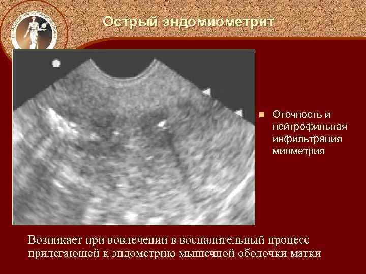 Острый эндомиометрит n Отечность и нейтрофильная инфильтрация миометрия Возникает при вовлечении в воспалительный процесс