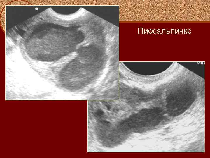 Пиосальпинкс 