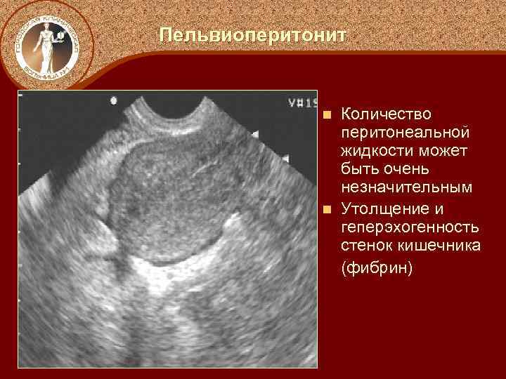 Клиническая картина пельвиоперитонита