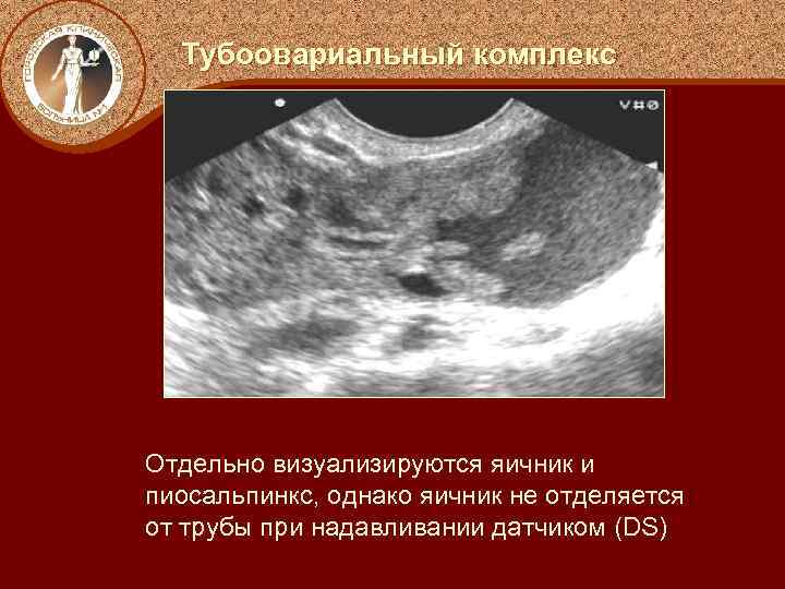 Тубоовариальный комплекс Отдельно визуализируются яичник и пиосальпинкс, однако яичник не отделяется от трубы при