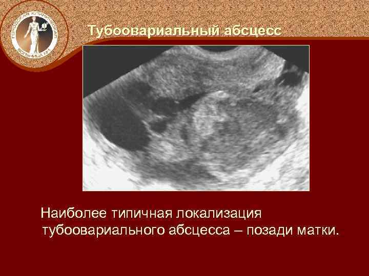 Тубоовариальный абсцесс Наиболее типичная локализация тубоовариального абсцесса – позади матки. 
