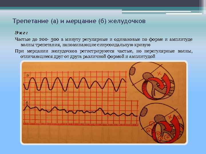 Трепетание (а) и мерцание (б) желудочков Экг: Частые до 200 300 в минуту регулярные