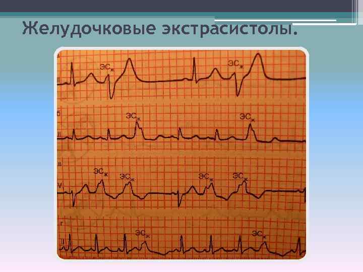 Желудочковые экстрасистолы. 