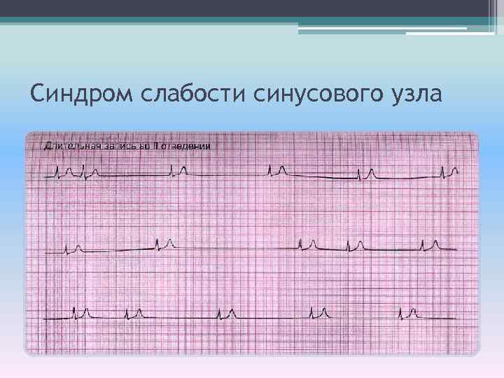 Синдром слабости синусового узла 